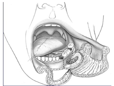 Cancer Of Buccal Mucosa